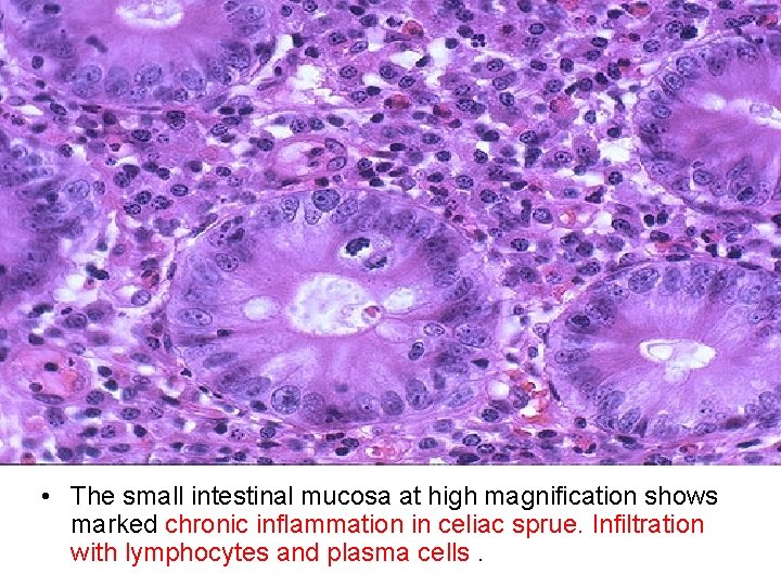  • The small intestinal mucosa at high magnification shows marked chronic inflammation in