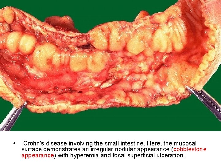  • Crohn's disease involving the small intestine. Here, the mucosal surface demonstrates an