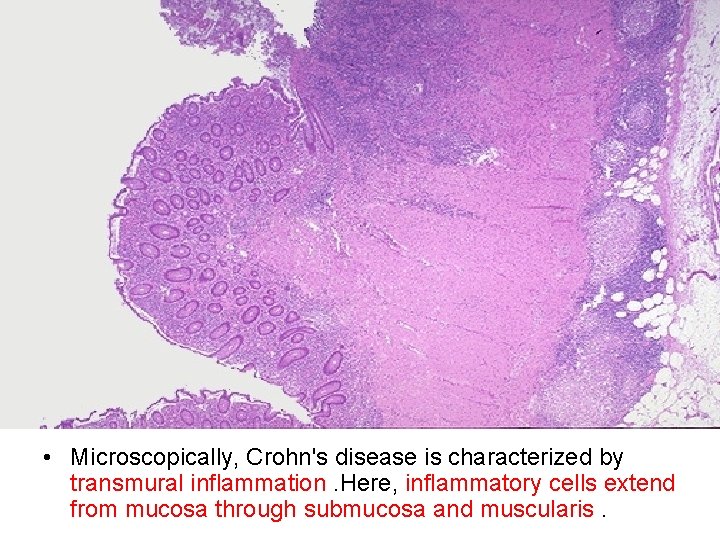  • Microscopically, Crohn's disease is characterized by transmural inflammation. Here, inflammatory cells extend