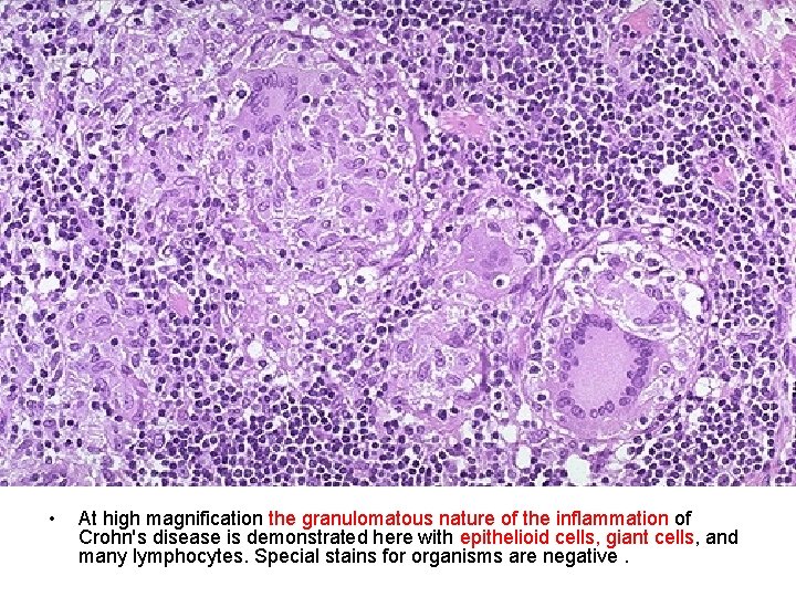  • At high magnification the granulomatous nature of the inflammation of Crohn's disease