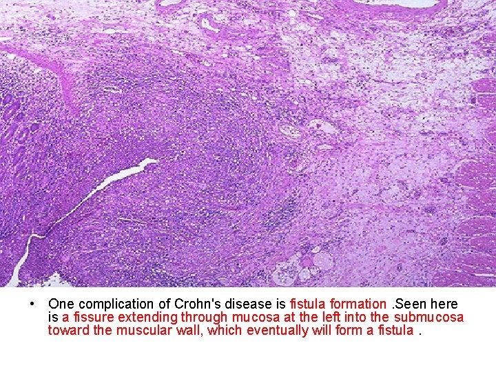  • One complication of Crohn's disease is fistula formation. Seen here is a