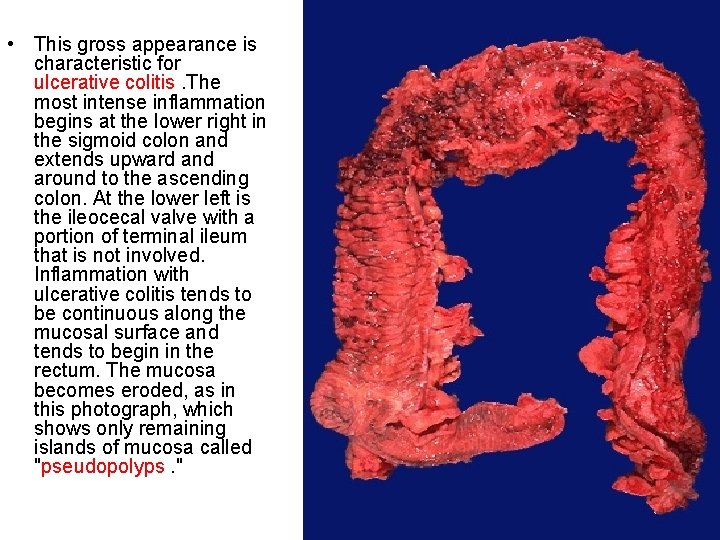  • This gross appearance is characteristic for ulcerative colitis. The most intense inflammation