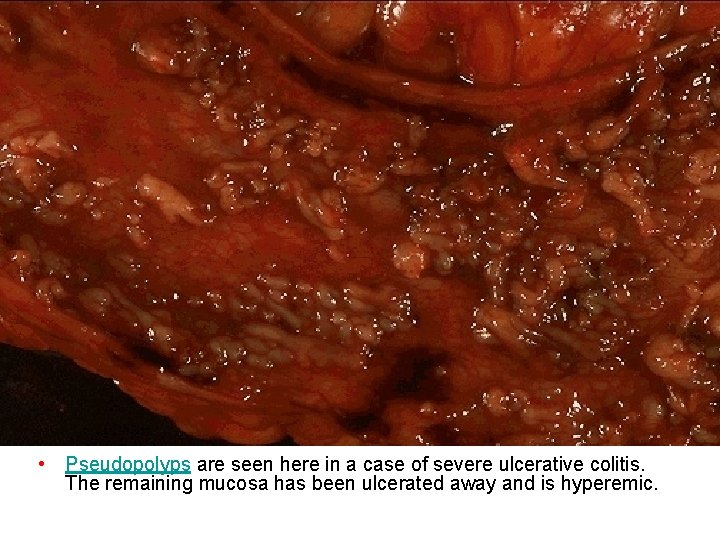  • Pseudopolyps are seen here in a case of severe ulcerative colitis. The