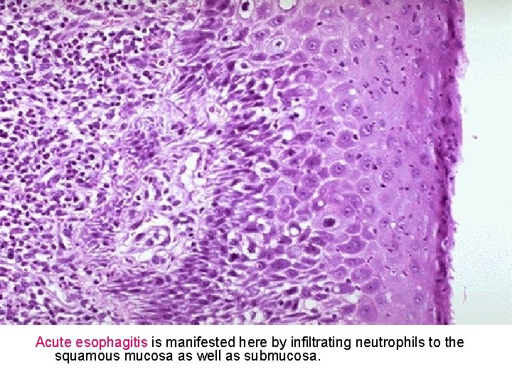 Acute esophagitis is manifested here by infiltrating neutrophils to the squamous mucosa as well