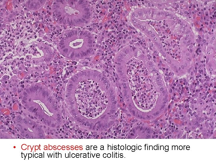  • Crypt abscesses are a histologic finding more typical with ulcerative colitis. 
