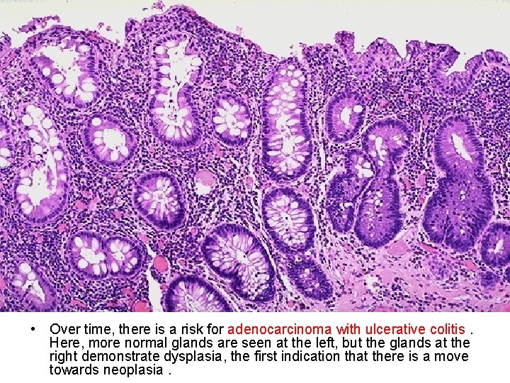  • Over time, there is a risk for adenocarcinoma with ulcerative colitis. Here,