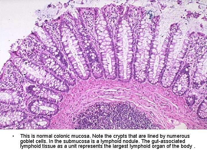  • This is normal colonic mucosa. Note the crypts that are lined by