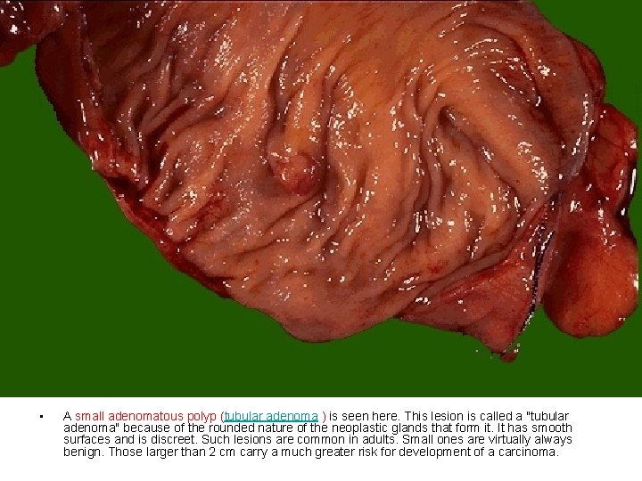  • A small adenomatous polyp (tubular adenoma ) is seen here. This lesion