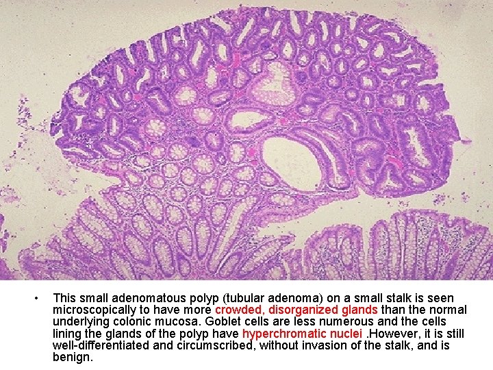  • This small adenomatous polyp (tubular adenoma) on a small stalk is seen