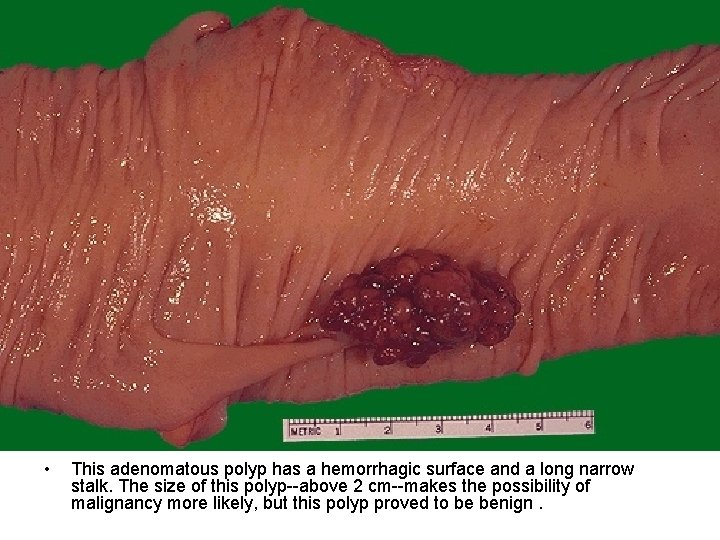  • This adenomatous polyp has a hemorrhagic surface and a long narrow stalk.