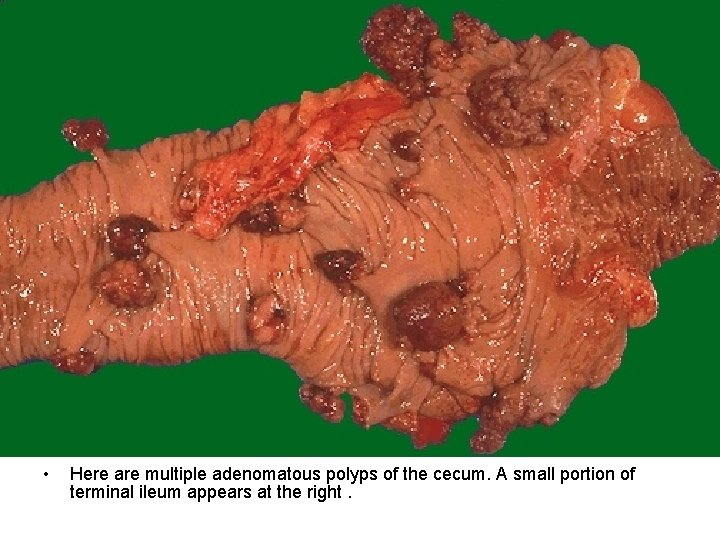  • Here are multiple adenomatous polyps of the cecum. A small portion of