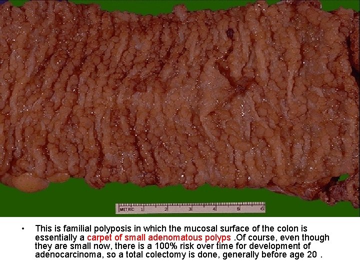  • This is familial polyposis in which the mucosal surface of the colon