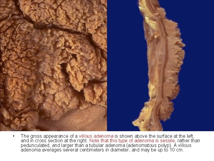  • The gross appearance of a villous adenoma is shown above the surface