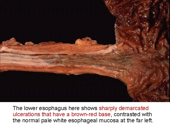 The lower esophagus here shows sharply demarcated ulcerations that have a brown-red base, contrasted