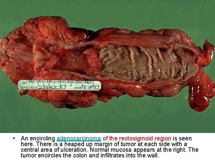  • An encircling adenocarcinoma of the rectosigmoid region is seen here. There is