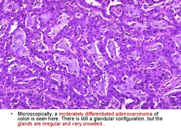  • Microscopically, a moderately differentiated adenocarcinoma of colon is seen here. There is