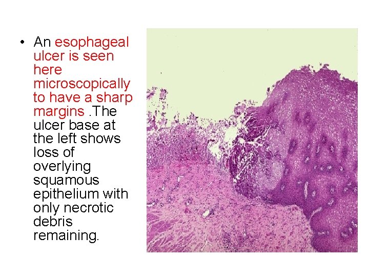  • An esophageal ulcer is seen here microscopically to have a sharp margins.