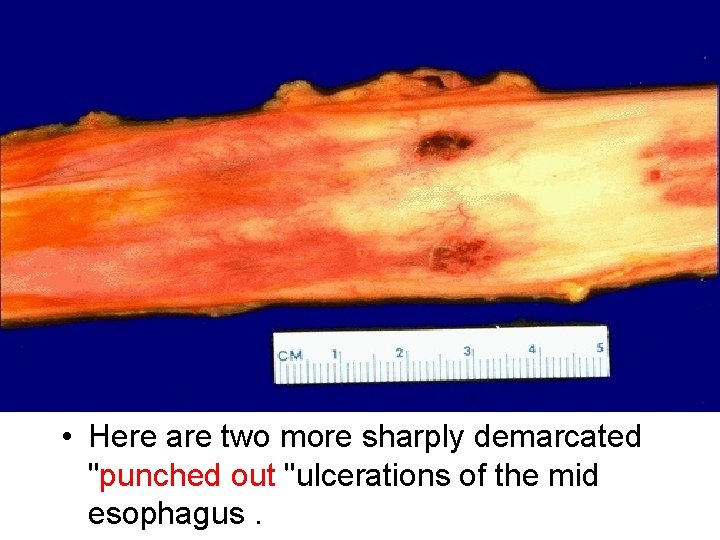  • Here are two more sharply demarcated "punched out "ulcerations of the mid
