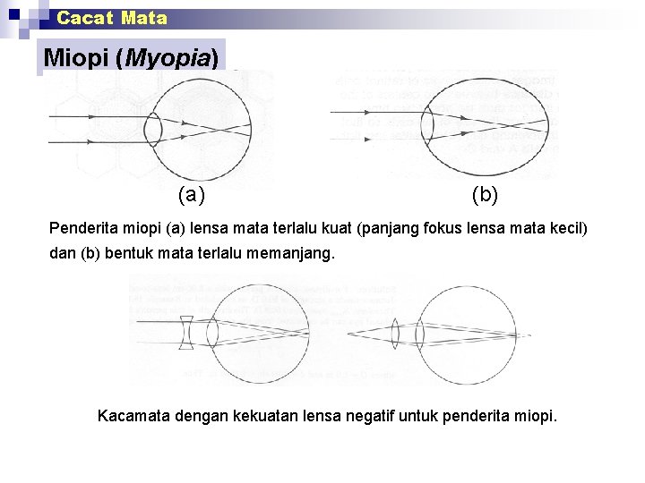 Cacat Mata Miopi (Myopia) (b) Penderita miopi (a) lensa mata terlalu kuat (panjang fokus