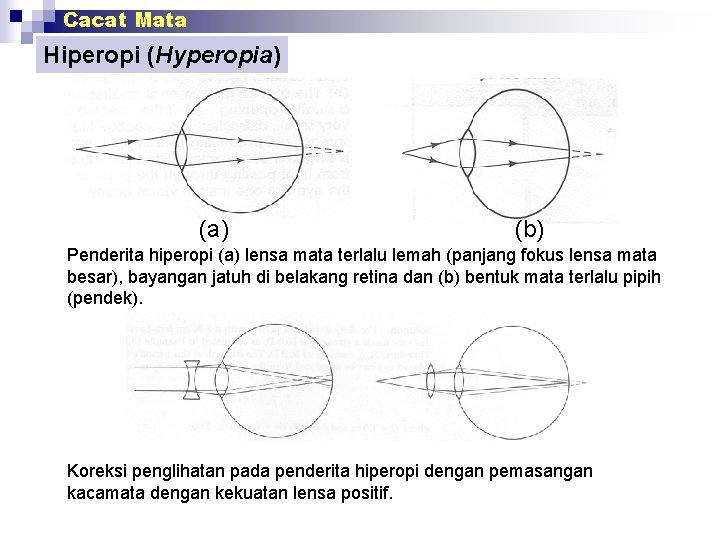 Cacat Mata Hiperopi (Hyperopia) (b) Penderita hiperopi (a) lensa mata terlalu lemah (panjang fokus