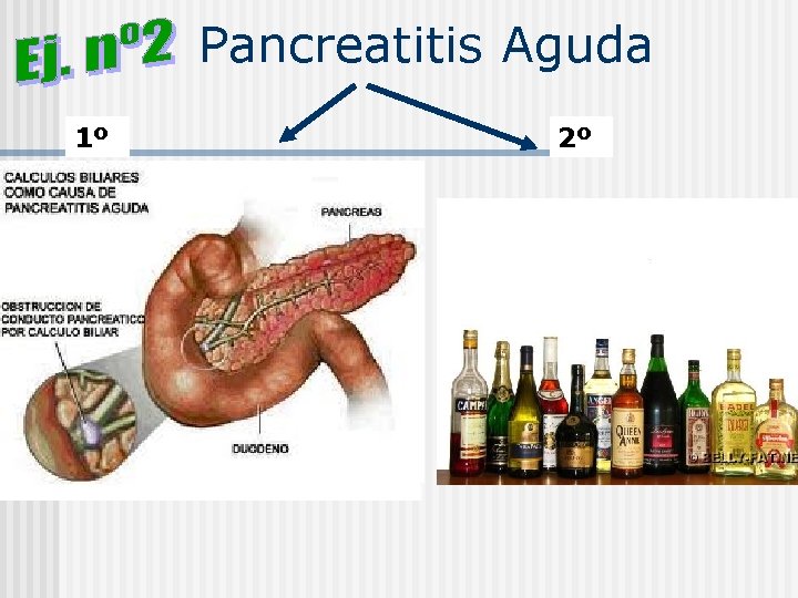 Pancreatitis Aguda 1º 2º 