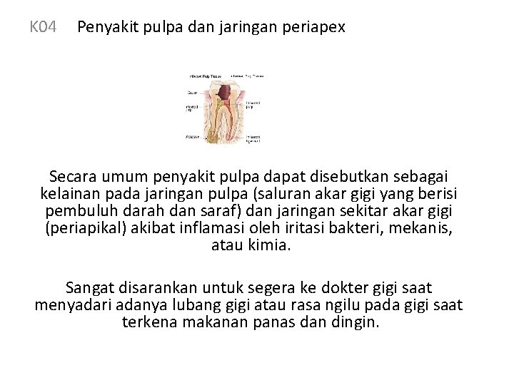 K 04 Penyakit pulpa dan jaringan periapex Secara umum penyakit pulpa dapat disebutkan sebagai