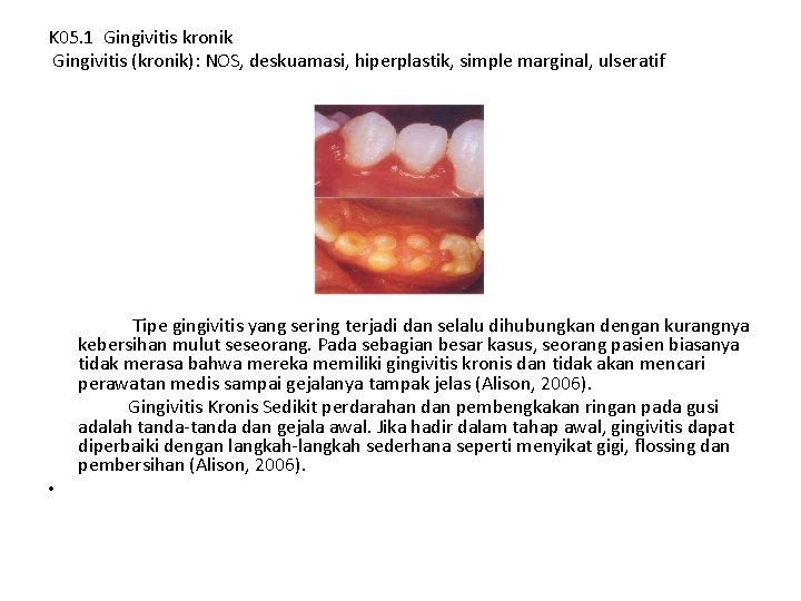 K 05. 1 Gingivitis kronik Gingivitis (kronik): NOS, deskuamasi, hiperplastik, simple marginal, ulseratif Tipe