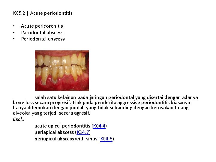 K 05. 2 | Acute periodontitis • • • Acute pericoronitis Parodontal abscess Periodontal