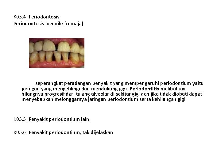 K 05. 4 Periodontosis juvenile [remaja] seperangkat peradangan penyakit yang mempengaruhi periodontium yaitu jaringan