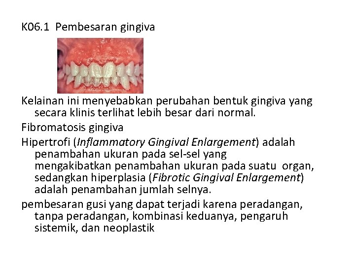 K 06. 1 Pembesaran gingiva Kelainan ini menyebabkan perubahan bentuk gingiva yang secara klinis