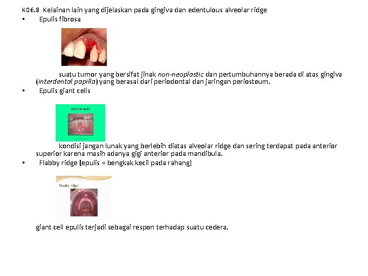 K 06. 8 Kelainan lain yang dijelaskan pada gingiva dan edentulous alveolar ridge •