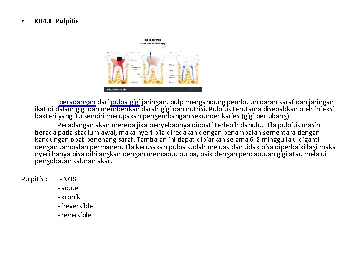  • K 04. 0 Pulpitis peradangan dari pulpa gigi jaringan. pulp mengandung pembuluh