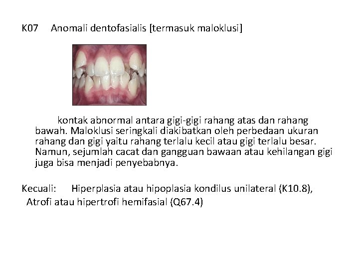 K 07 Anomali dentofasialis [termasuk maloklusi] kontak abnormal antara gigi-gigi rahang atas dan rahang