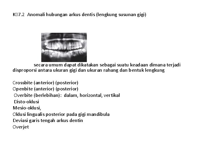 K 07. 2 Anomali hubungan arkus dentis (lengkung susunan gigi) secara umum dapat dikatakan