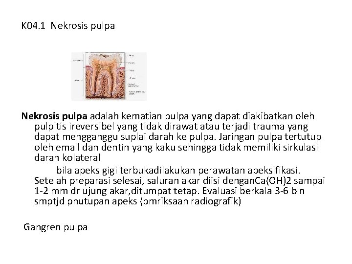 K 04. 1 Nekrosis pulpa adalah kematian pulpa yang dapat diakibatkan oleh pulpitis ireversibel