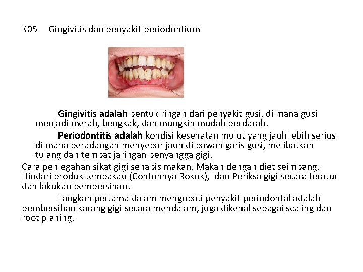K 05 Gingivitis dan penyakit periodontium Gingivitis adalah bentuk ringan dari penyakit gusi, di