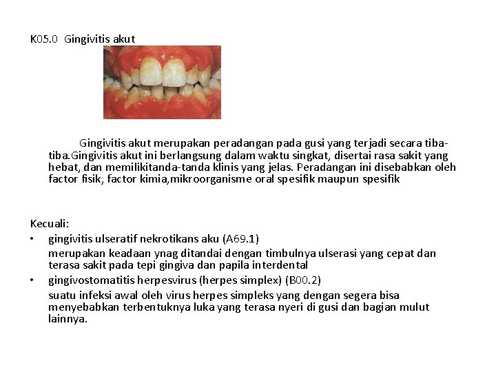 K 05. 0 Gingivitis akut merupakan peradangan pada gusi yang terjadi secara tiba. Gingivitis