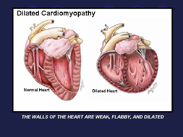 THE WALLS OF THE HEART ARE WEAK, FLABBY, AND DILATED 