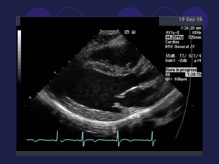 Normal Echocardiogram 