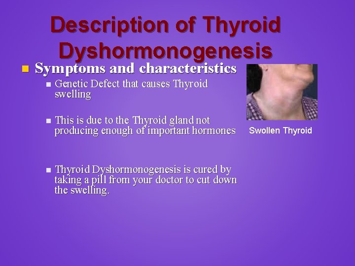 n Description of Thyroid Dyshormonogenesis Symptoms and characteristics n Genetic Defect that causes Thyroid