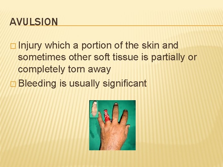 AVULSION � Injury which a portion of the skin and sometimes other soft tissue