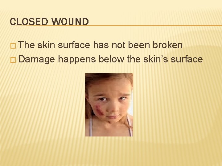CLOSED WOUND � The skin surface has not been broken � Damage happens below