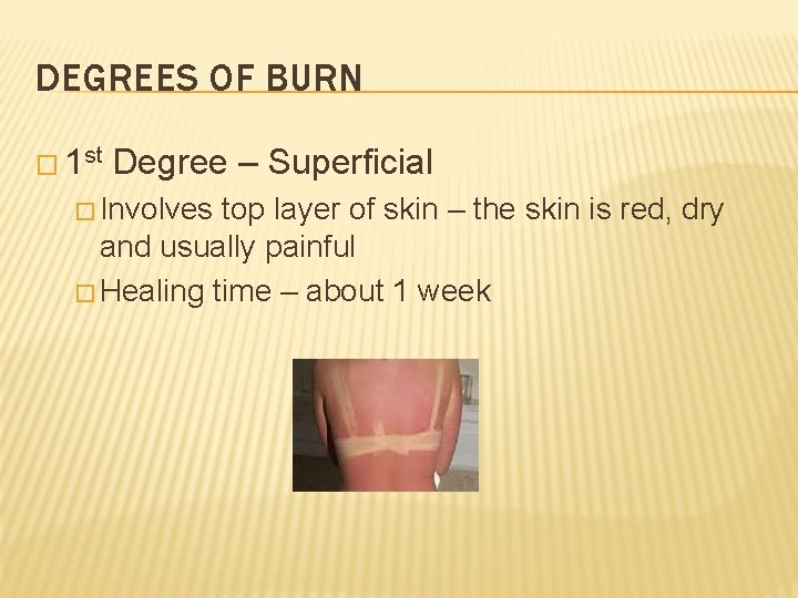 DEGREES OF BURN � 1 st Degree – Superficial � Involves top layer of