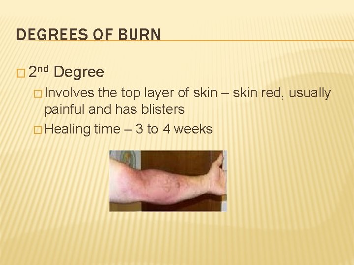 DEGREES OF BURN � 2 nd Degree � Involves the top layer of skin