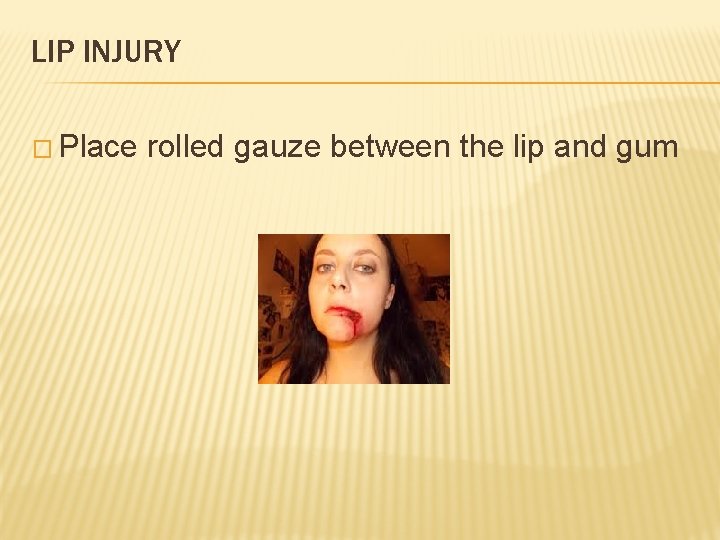 LIP INJURY � Place rolled gauze between the lip and gum 