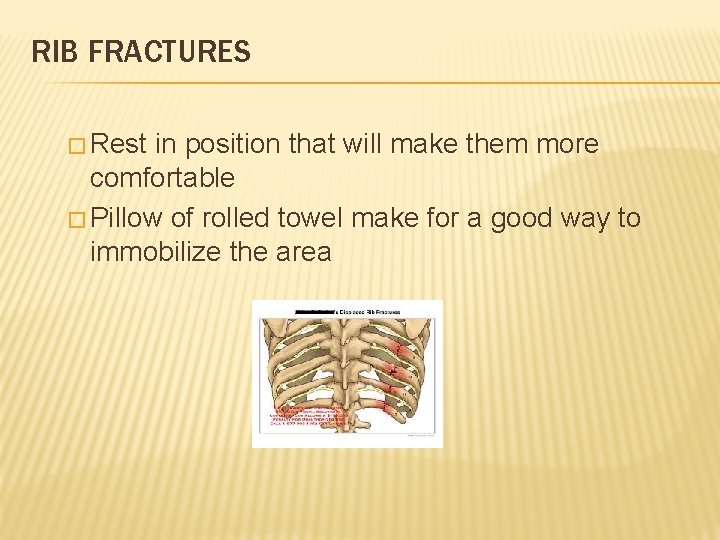 RIB FRACTURES � Rest in position that will make them more comfortable � Pillow