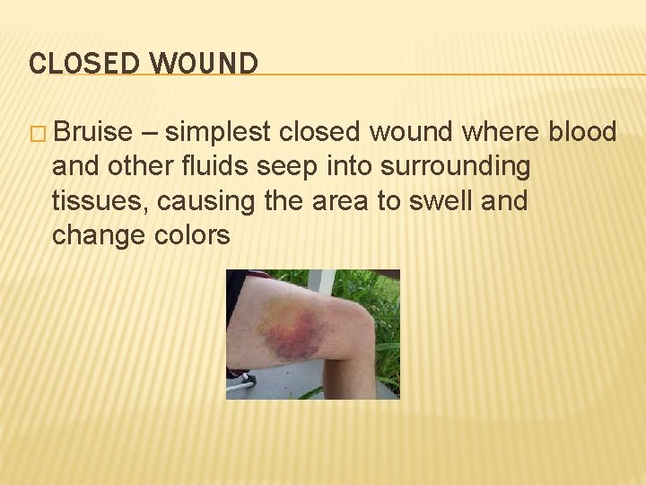 CLOSED WOUND � Bruise – simplest closed wound where blood and other fluids seep
