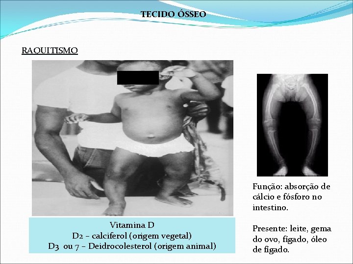 TECIDO ÓSSEO RAQUITISMO Função: absorção de cálcio e fósforo no intestino. Vitamina D D