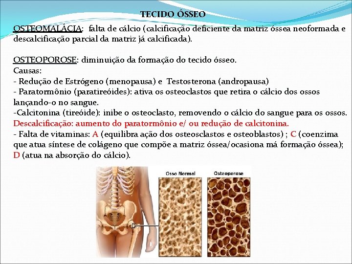 TECIDO ÓSSEO OSTEOMALÁCIA: OSTEOMALÁCIA falta de cálcio (calcificação deficiente da matriz óssea neoformada e
