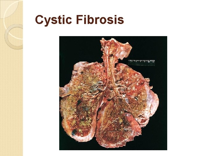 Cystic Fibrosis 